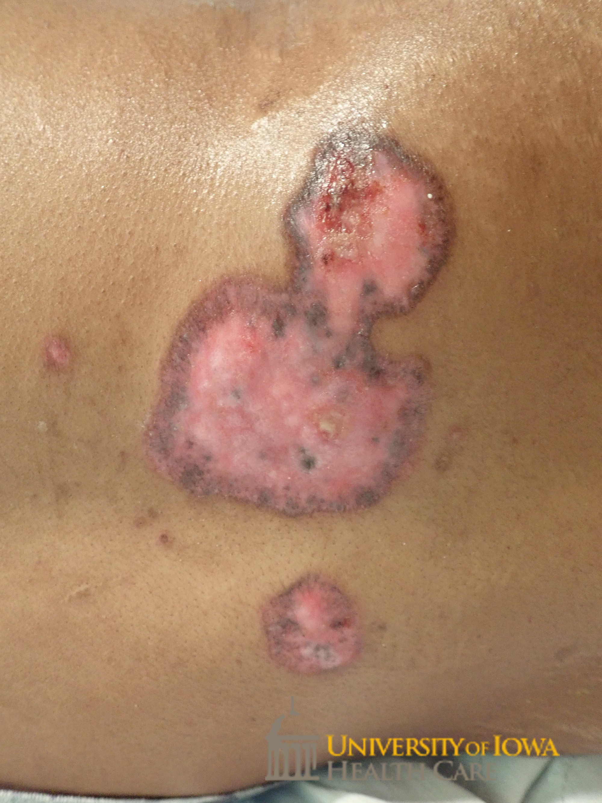 Well demaracated, shiny, and atrophic plaque with rim of hyperpigmentation and focal area of heme-crust. (click images for higher resolution).